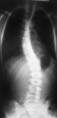 /album/fotogaleria/desviacion-del-rakis-escoliosis-jpg/